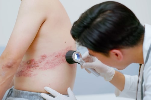 El herpes zóster está afectando a un número creciente de adultos&nbsp;mayores